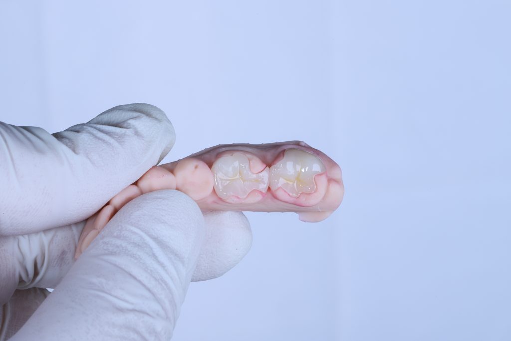 Endodontic,Treatment,In,Dental,Dentistry,,Porcelain,Filling,Technique,Applied,After