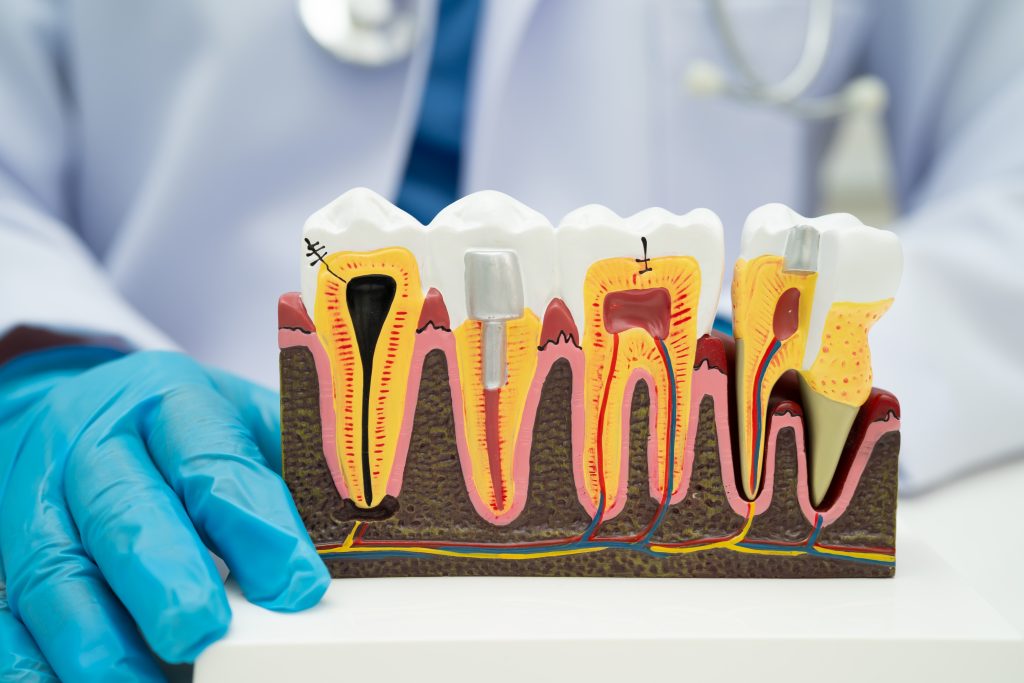 Dental,Implant,Artificial,Tooth,Roots,Into,Jaw,Root,Canal,Of