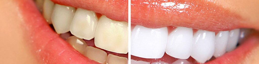 Image showing a woman's teeth before and after whitening, highlighting the enhanced whiteness and overall dental appearance.