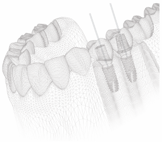 A dental implant featuring a natural-looking tooth attached to it, illustrating a common restorative dental procedure